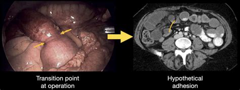 Abdominal CT: closed loop • LITFL • Radiology Library