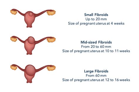 Fibroid Types, Sizes, Location, & FIGO Classifications Explained