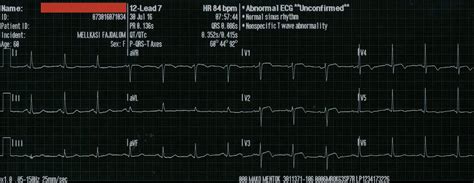 Dr. Smith's ECG Blog: de Winter's T-waves evolve into Wellens' waves