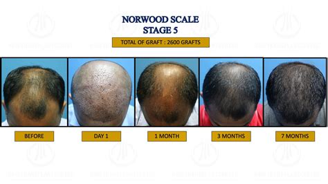 Norwood Stage 5- Hair Transplant Centre - Malaysia Hair Treatment