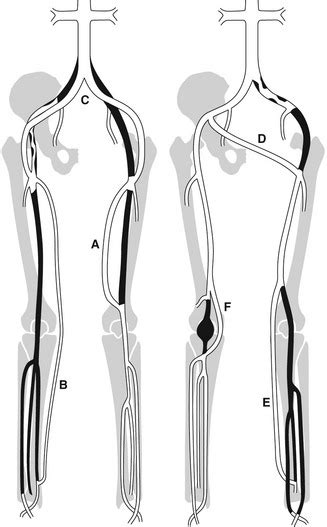 Graft surveillance and preoperative vein mapping for bypass surgery | Radiology Key