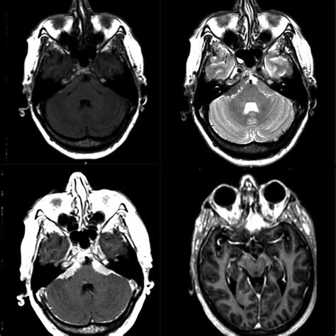 MRI sequences demonstrating typical appearance of extensive skull base ...