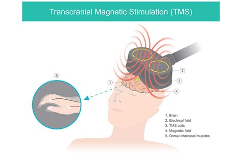 Transcranial Magnetic Stimulation Cost | South County Psychiatry