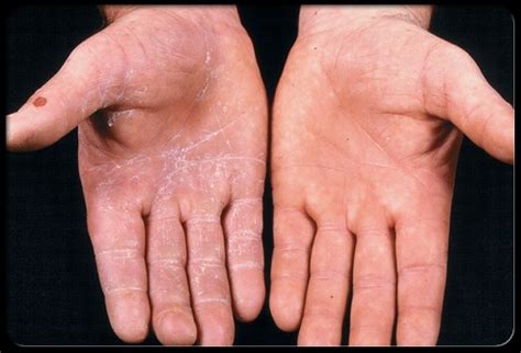 Ringworm of the hand (tinea manus) - causes hyperkeratosis, scaling and itching | Grzybica ...