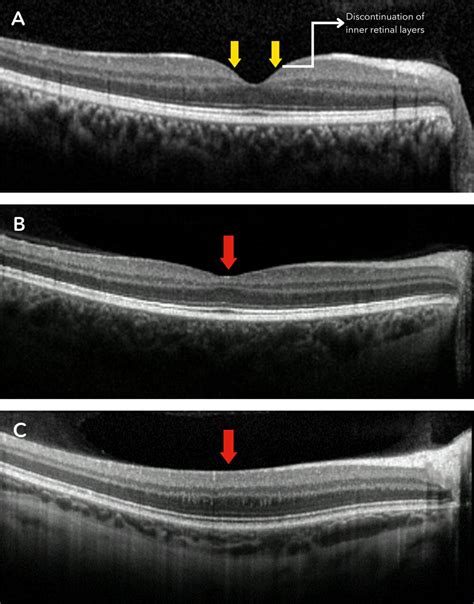 Foveal Hypoplasia Diagnosis with OCT & Clinical Management - mivision