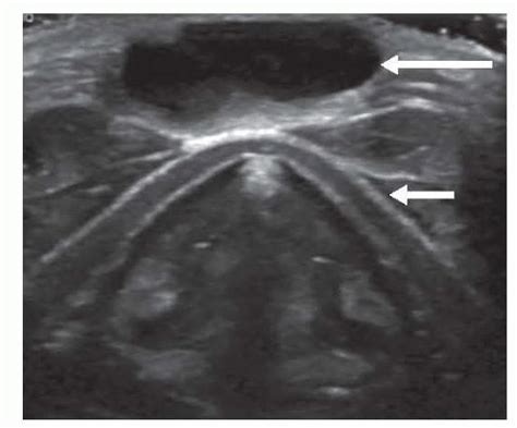 Thyroglossal Duct Cyst Ultrasound Images