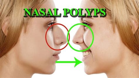 Nasal Polyps Shrinkage Diet – Foods to Shrink Nasal Polyps – NaturWarriors