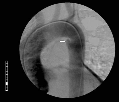 Remnant of a non-patent ductus arteriosus mimicking traumatic thoracic aorta transection: a case ...