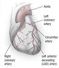 Bypass or angioplasty with stenting: How do you choose? - Harvard Health