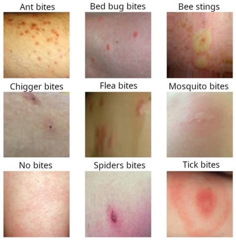 What is the Difference between Mosquito Bites And Chigger Bites?: Spot the Clues