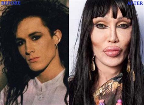 Pete Burns Plastic Surgery1 Photo Before and After : CELEB-SURGERY.COM