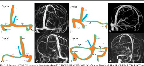 Evaluation of dural venous sinuses and confluence of sinuses via MRI venography: anatomy ...