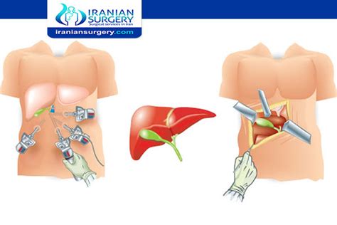 Laparotomy vs Laparoscopy | Laparoscopy vs Laparotomy| Iranian Surgery