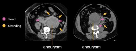 Abdominal CT: aortic aneurysm • LITFL • Radiology Library