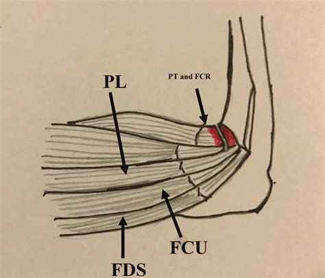 Illustration shows the medial elbow musculotendinous anatomy. FCU ...