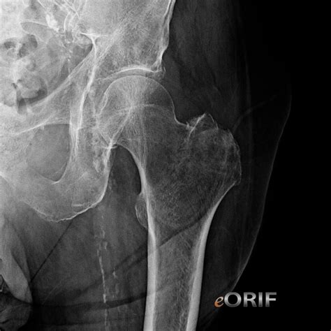 Greater Trochanter Hip Fracture S72.109A 820.20 | eORIF