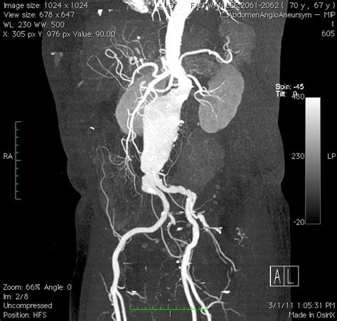 Abdominal Aortic Aneurysm (AAA)