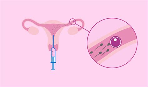 Homologous Artificial Insemination services at Miracle IVF Hospital