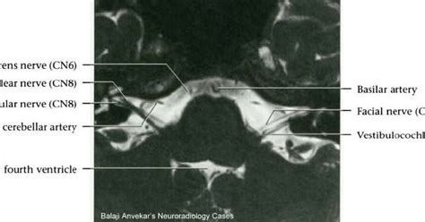 ArUn's MRI Protocols: 7TH NERVE MRI Protocol(Facial Nerve)