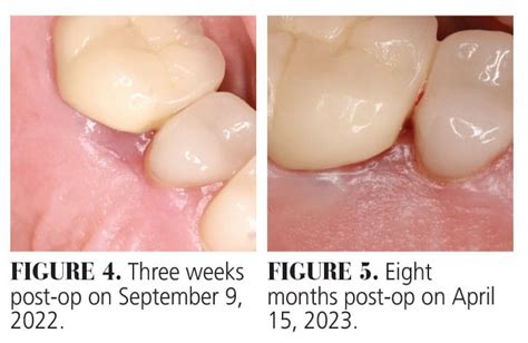 Use of Laser Therapy in Amalgam Tattoo Removal - Decisions in Dentistry