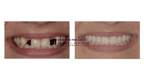 Photos des résultats avant après implant dentaire, invisalign , facettes