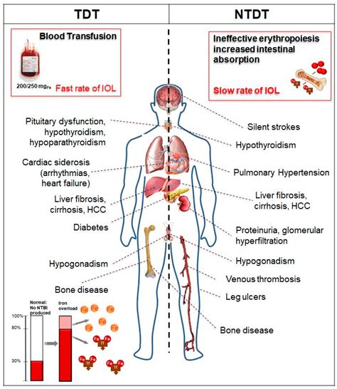 IJMS | Free Full-Text | Management of Iron Overload in Beta-Thalassemia ...