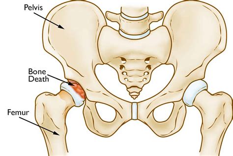 Osteonecrosis hip causes, stages, symptoms, diagnosis, treatment ...