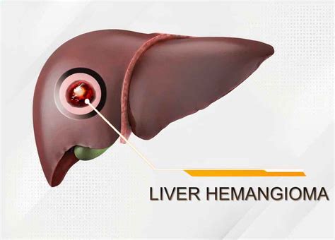 Can Liver Cancer Be Mistaken for Hemangioma? - A2Z Healthy