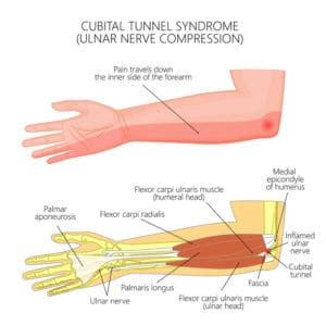 Elbow Conditions | Elbow Injuries | FORM Hand, Wrist & Elbow Institute