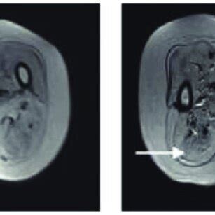 (A) MRI scan of lateral head of gastrocnemius (arrow) pre-cell therapy ...