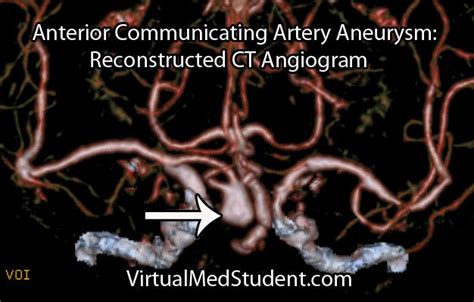 anterior communicating artery aneurysm symptoms - madalenegedeon