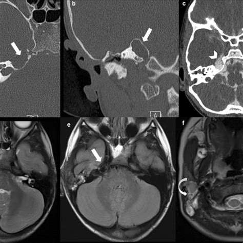 Five-year-old boy with right-sided CSF otorrhea. Axial a and coronal b... | Download Scientific ...