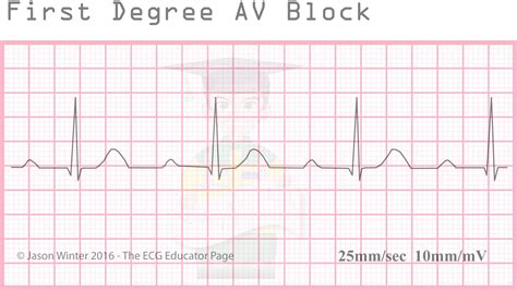 First Degree AV Block Strip