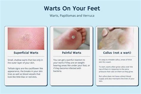 How To Treat Your Plantar Wart | 3 Podiatrist Approved Options