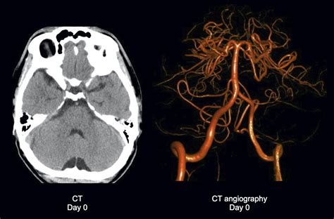 Internuclear Ophthalmoplegia Mri