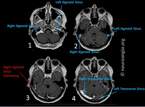 Pulsatile Tinnitus Venous Sinus Stenosis and Stenting | neuroangio.org