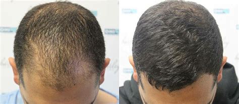 The Best Place to Get a Hair Transplant - DHI International