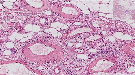 Angiomyolipoma - Kidney, Histopathology - YouTube