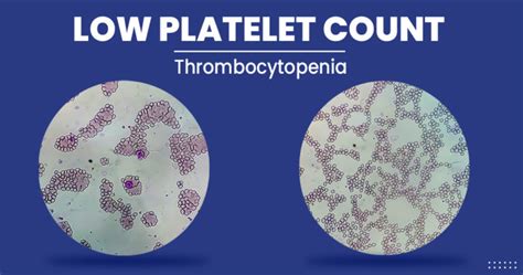 Low platelet count - Symptoms , Diagnosis, Treatment, and More