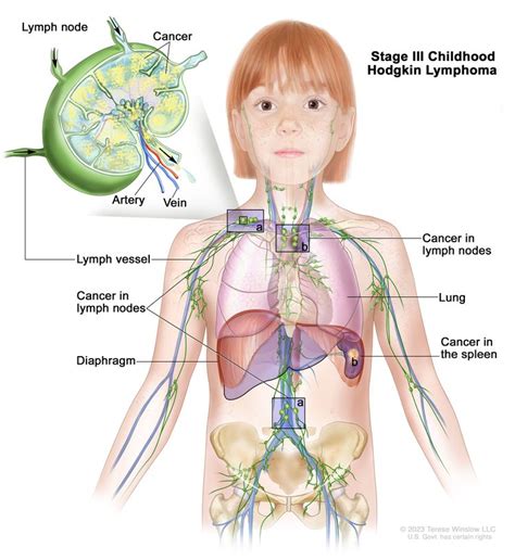 Childhood Hodgkin Lymphoma Treatment - NCI