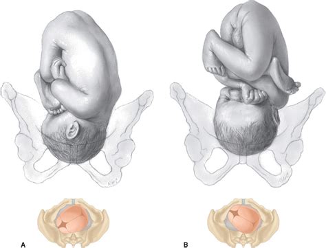 Normal Labor | Obgyn Key