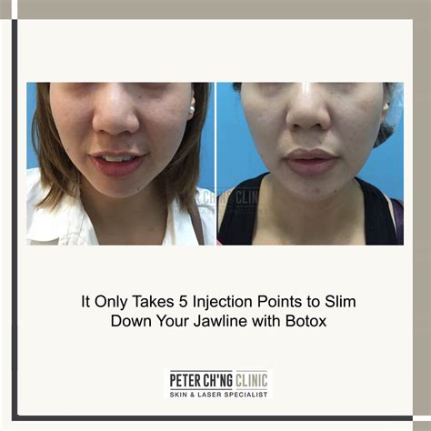 Jawline Reshaping with Botox – 5 Interesting Facts | Peter Ch'ng Skin Specialist - KL, Malaysia