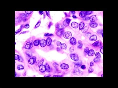 Lab or Diagnostic Findings: Orphan Annie's Eyes Nuclei (papillary carcinoma of the thyroid ...