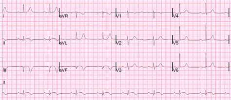 Illustrare Cordiali saluti allineamento ecg inverted r wave Alunno Amplificare radar