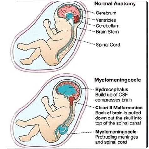 Myelomeningocele | Pediatric nursing, Nursing school survival, Myelomeningocele