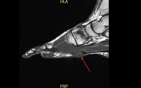 Plantar Fibroma Pictures Treatment Surgery Symptoms