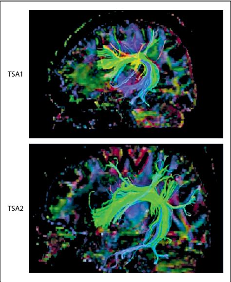 Figure 1 from Transcortical Sensory Aphasia after Left Frontal Lobe ...