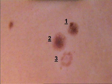 dermoscopy: Atypical (dysplastic) nevi