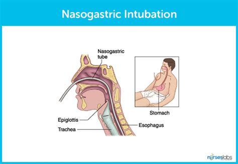 Nasogastric Intubation: Insertion Procedures & Technique