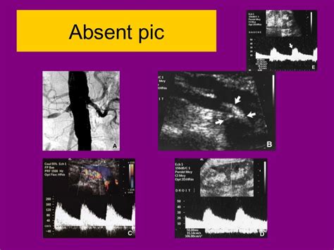 Renal doppler ultrasound